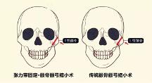 聯(lián)合麗格第 一醫(yī)院何照華院長(zhǎng)：張力帶固定顴骨內(nèi)推與傳統(tǒng)顴骨手術(shù)有何區(qū)別？
