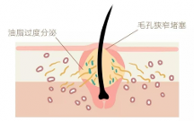青春期臉上長白色的小痘痘怎么辦？米迪豆專業(yè)祛痘值得信賴！